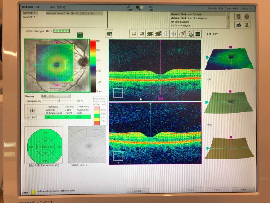 Zeiss Cirrus 5000 HD-OCT