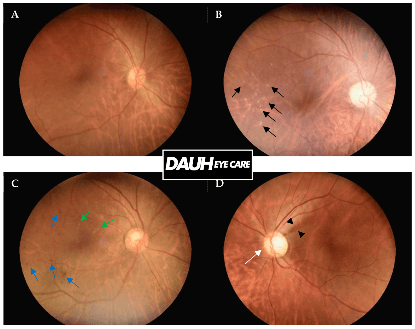 diagnostics-Non-Mydriatic-Operation