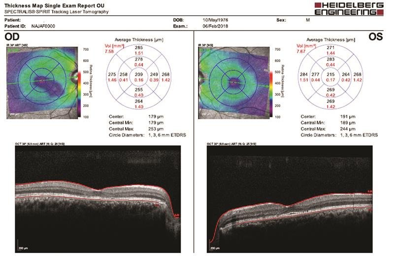SPECTRALIS Widefield